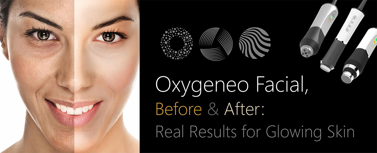 Oxygeneo Facial for glowing skin
